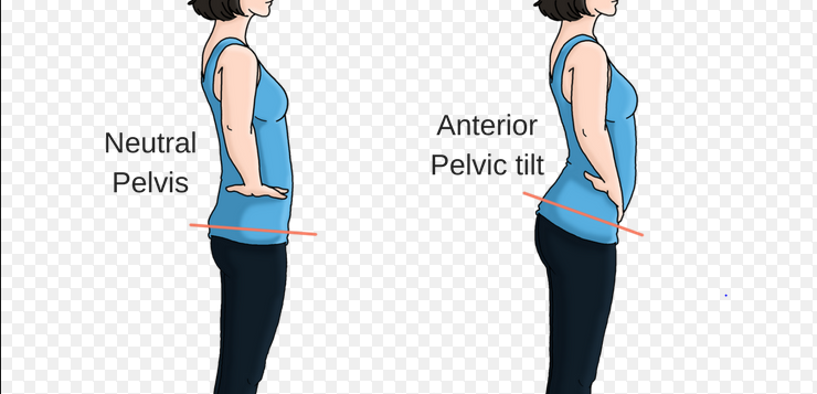 The anterior pelvic tilt.