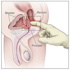Inflamed Prostate Hard Flaccid